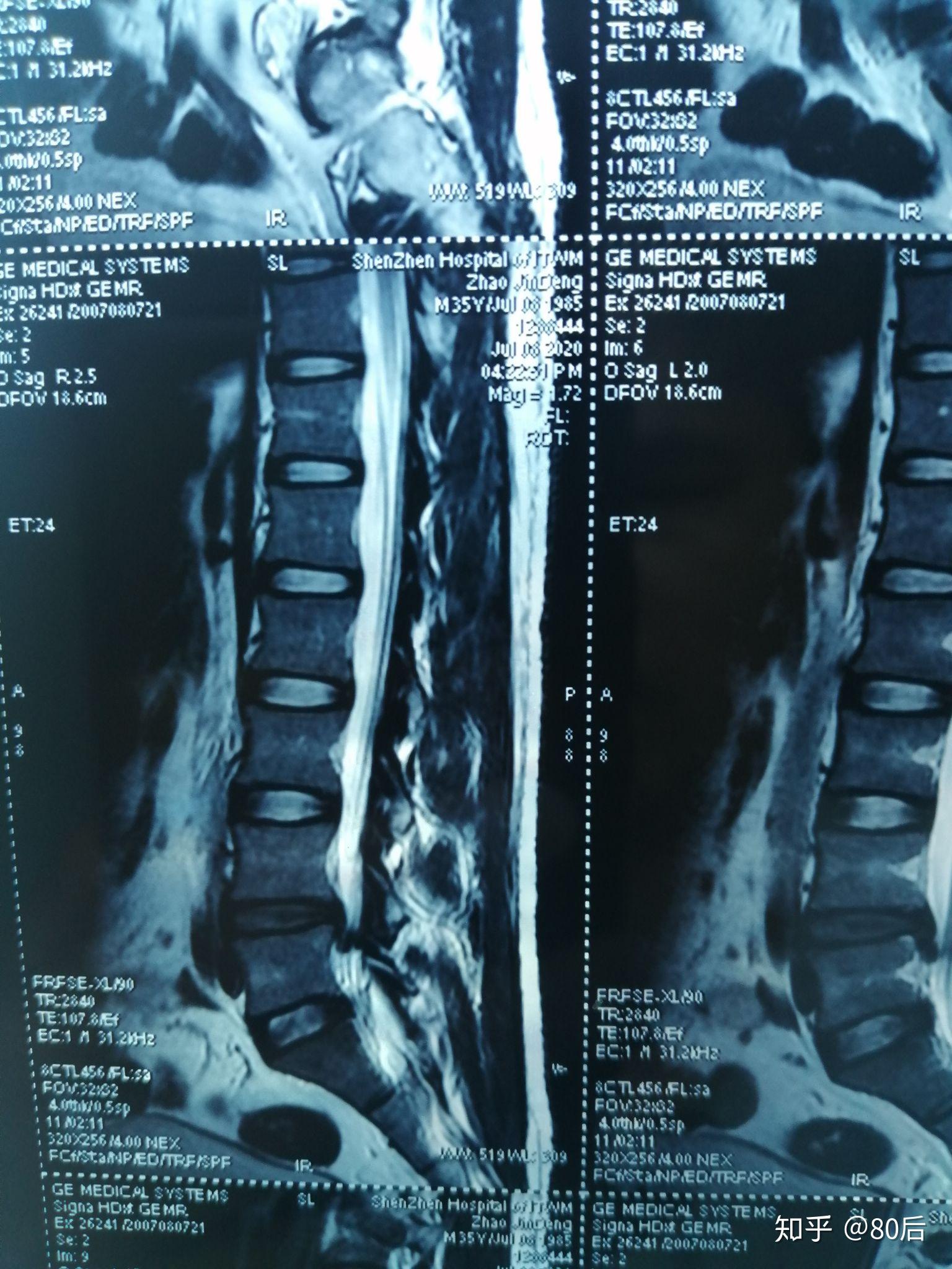 正常的腰椎片子图片