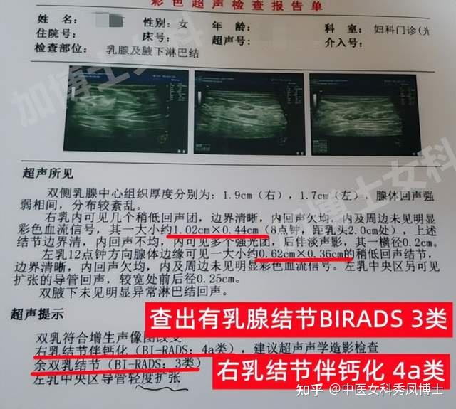 乳腺結節birads 3類消失案例