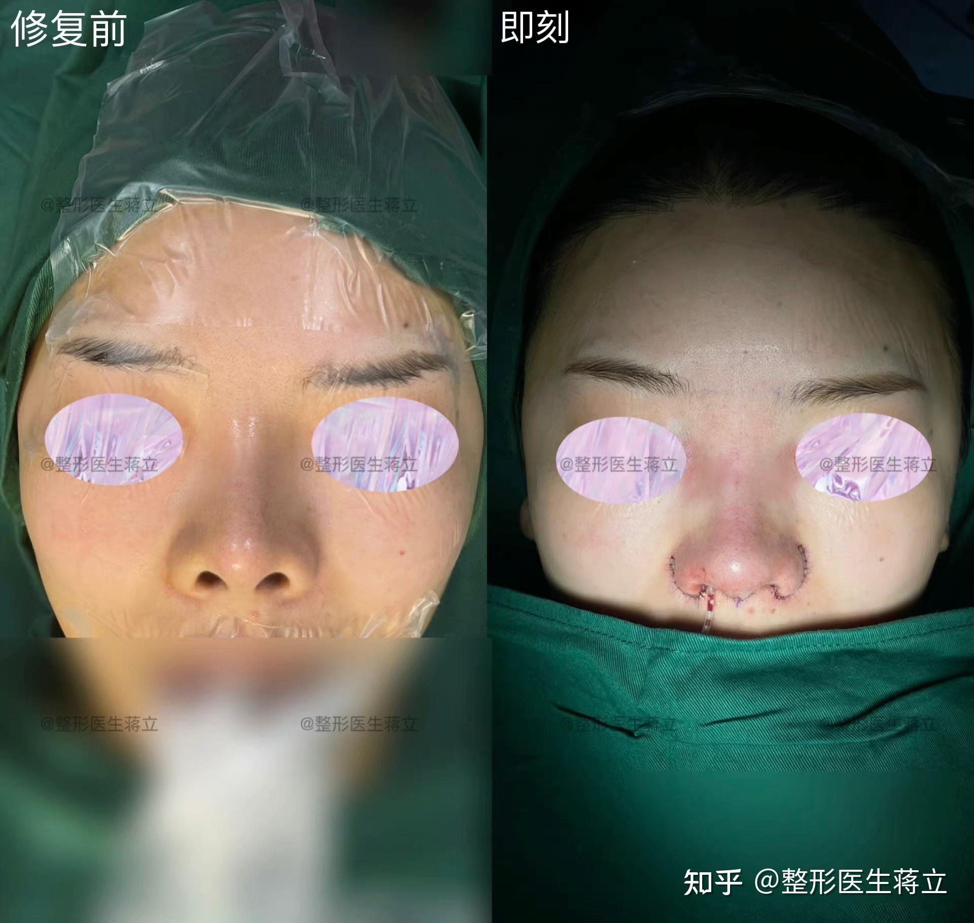 缩导致鼻头上扬鼻唇角大正面露鼻孔山根高起点高鼻翼宽鼻背稍歪术前术