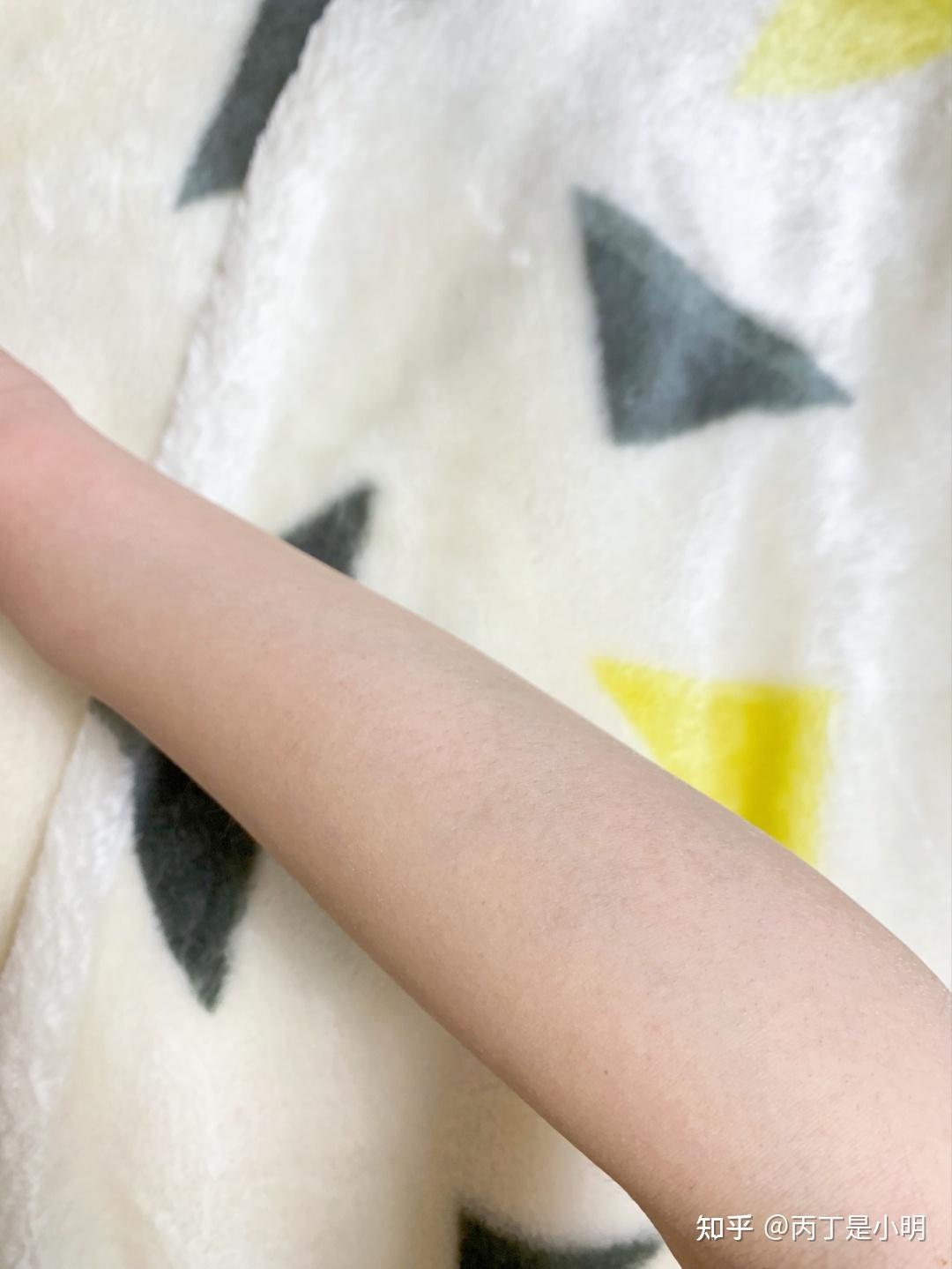 脱完12天的胳膊