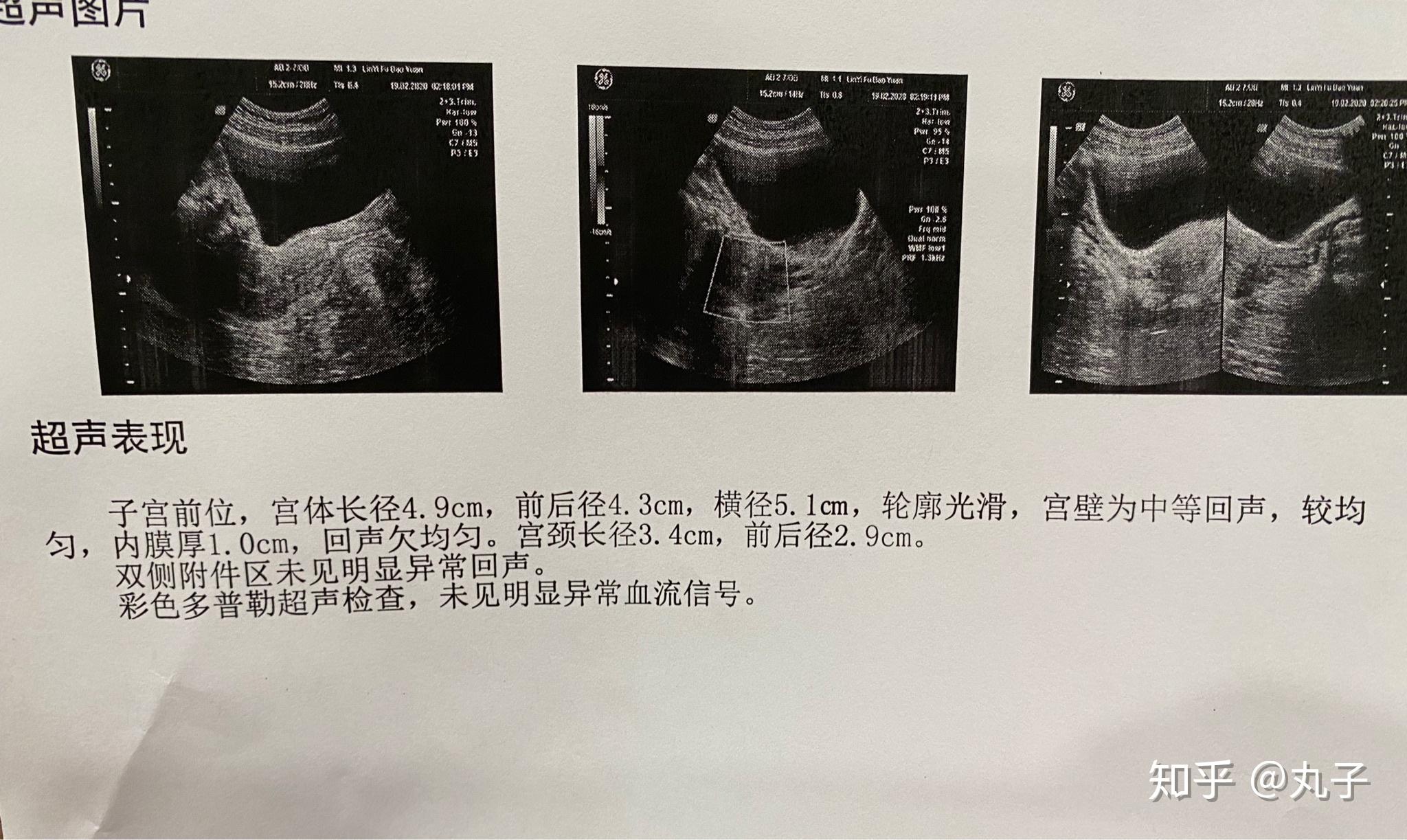孕56天大孕囊的药流过程记录高能配图