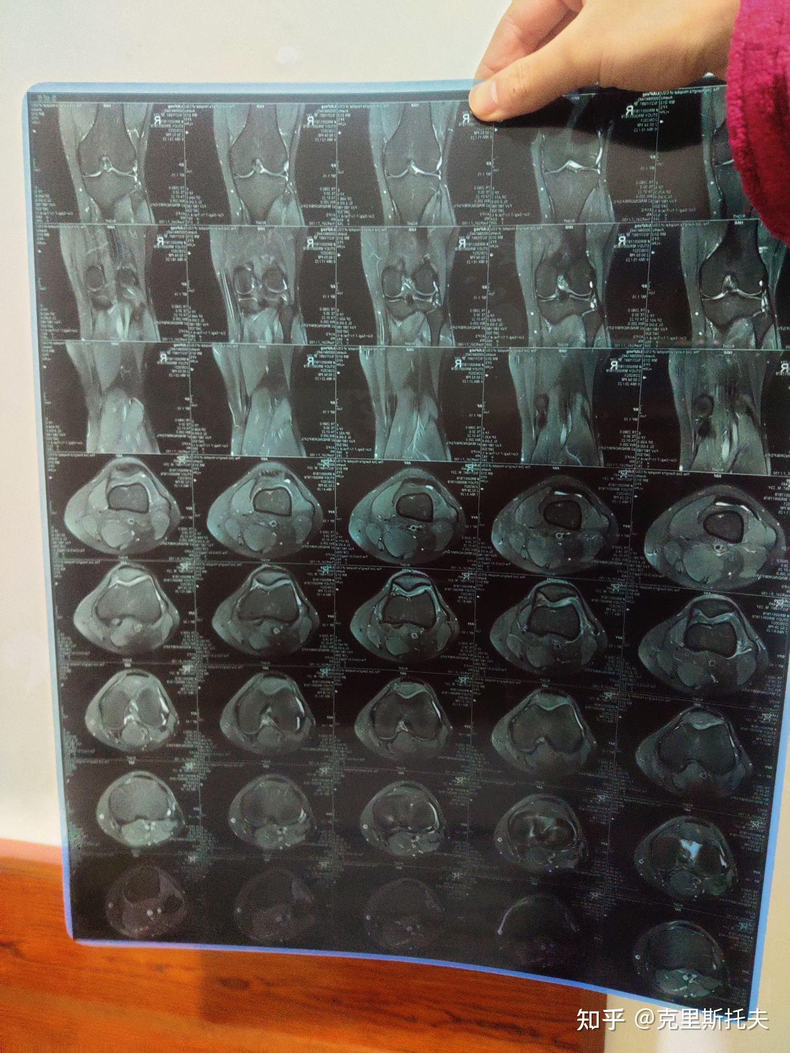髌腱炎核磁共振图片