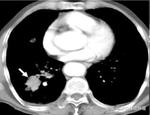 肺癌病例 周围型肺癌介入消融 全身热疗效果显著 知乎