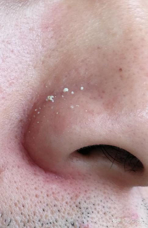 长黑头去医院看医生真的有用吗?