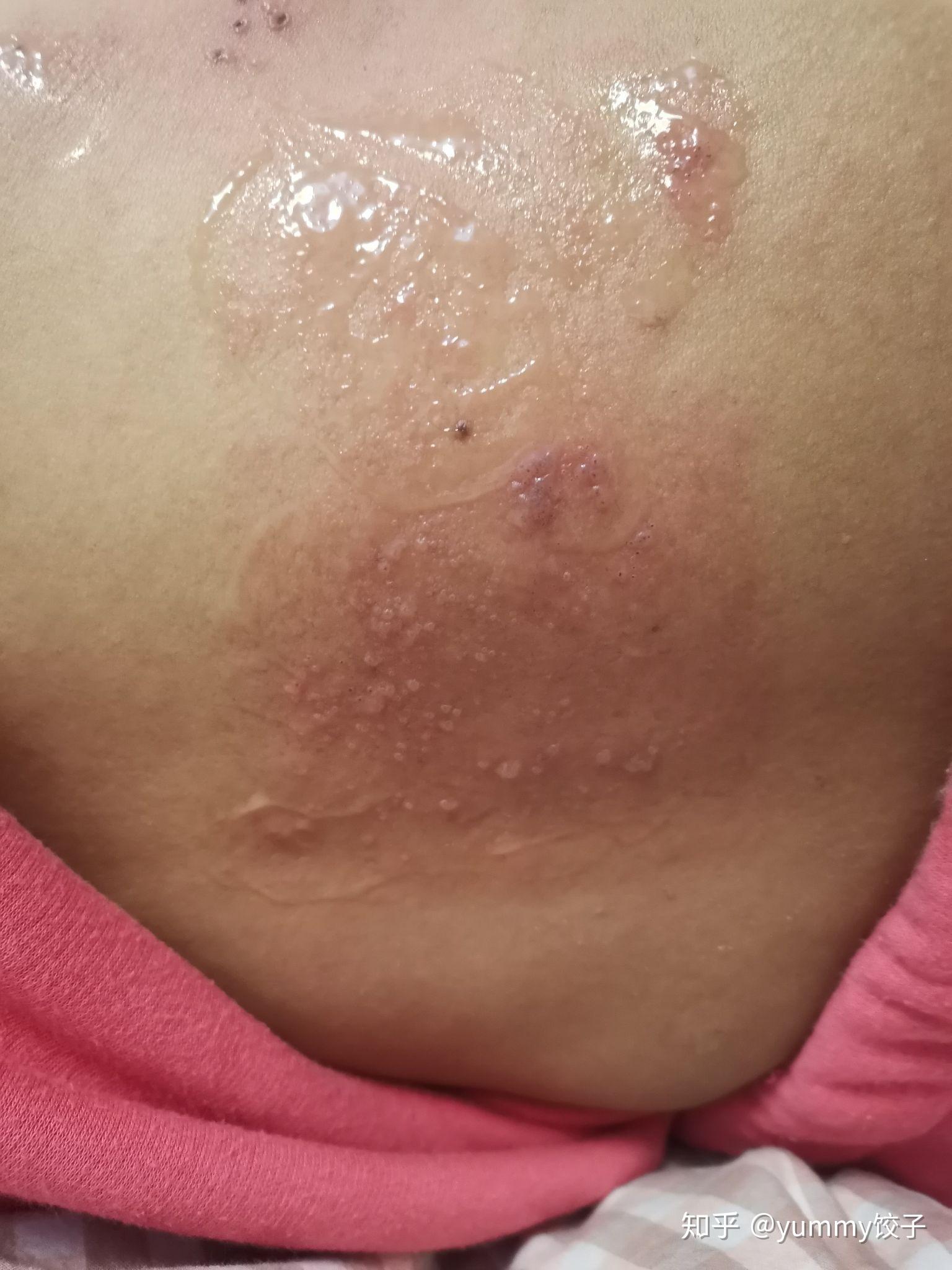 哺乳期———与带状疱疹抗争的日子