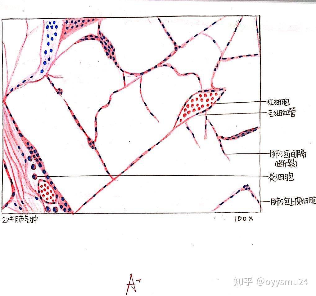 肾脓肿炎细胞肾贫血性梗死混合性血栓肉芽组织肝细胞脂肪变性这学期的