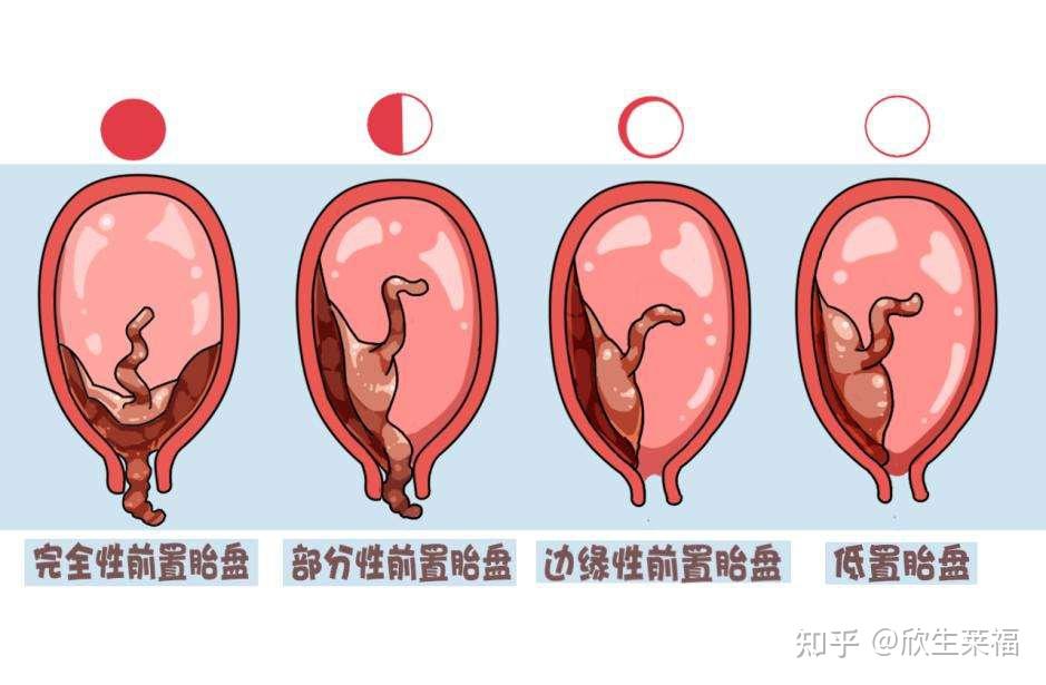 前置胎盘有4种,一张图带你秒懂