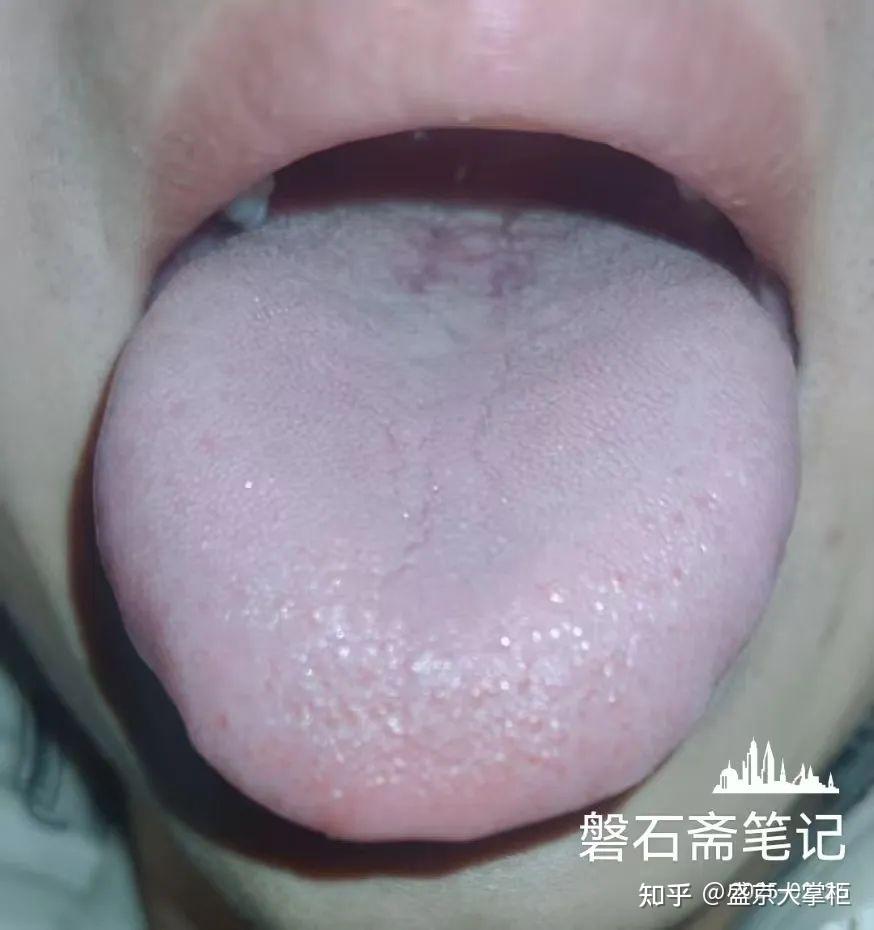 古中医上的舌诊,解构厚腻苔,附18张舌象图解及化浊汤 - 知乎