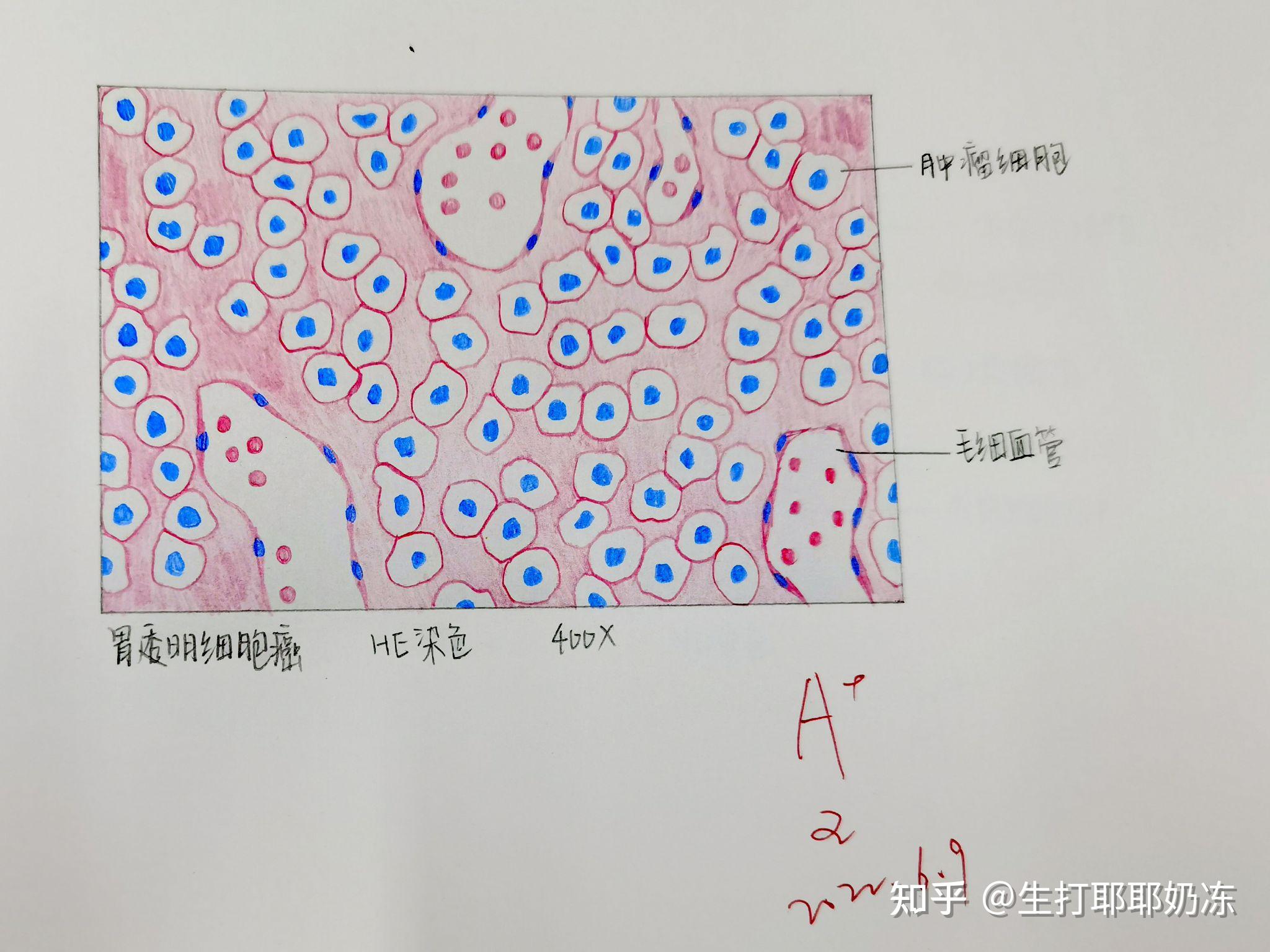 腺淋巴瘤红蓝铅笔图片