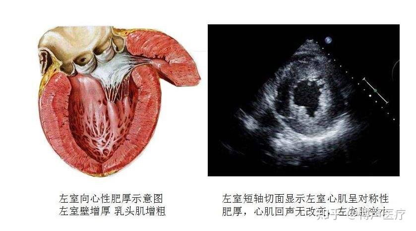 常可累及右心室功能下降,形成全心衰竭,主要表现为  ①颈静脉明显充盈