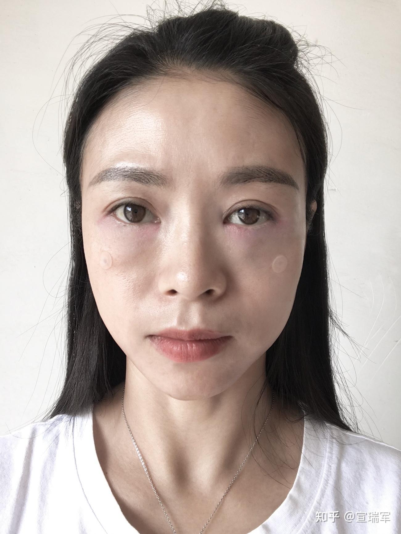 近期案例：北京眼部年轻化之外切祛眼袋+眉提升，15天 - 知乎
