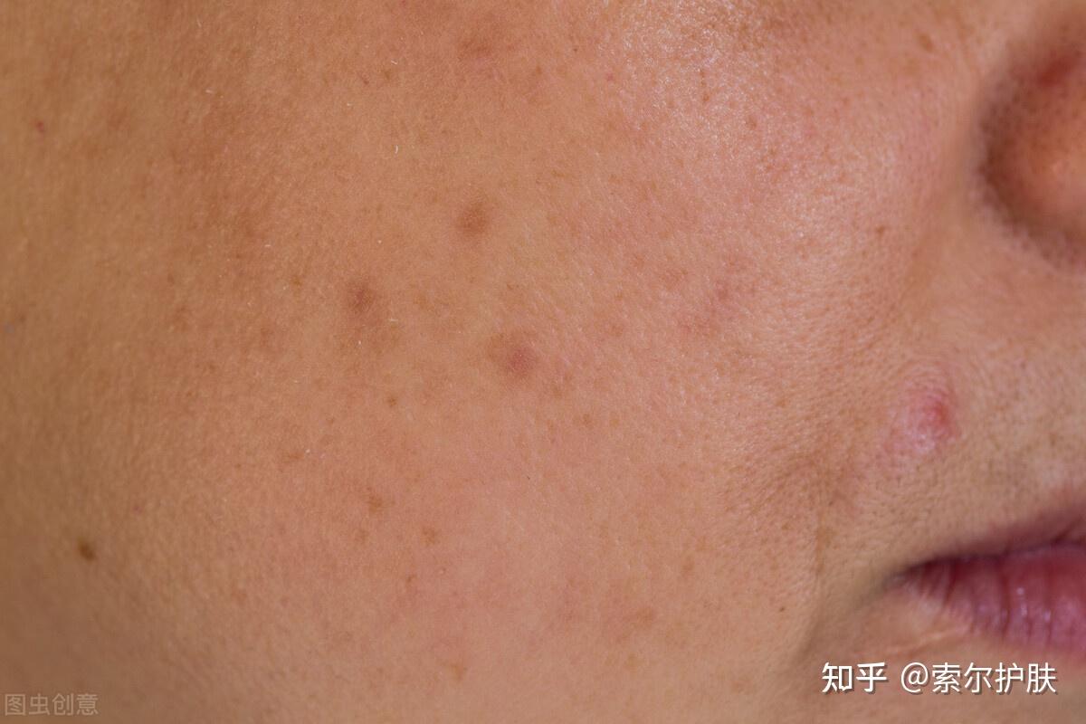 油性皮肤要想淡化斑点,首先要做好水油平衡,补水保湿,保证角质代谢