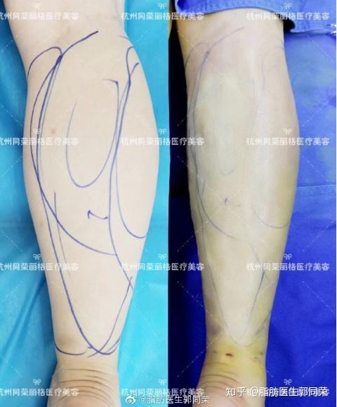 光纤溶脂前后对比2,抽脂瘦腿吸脂抽脂瘦腿在理论上来说是可以永久维持