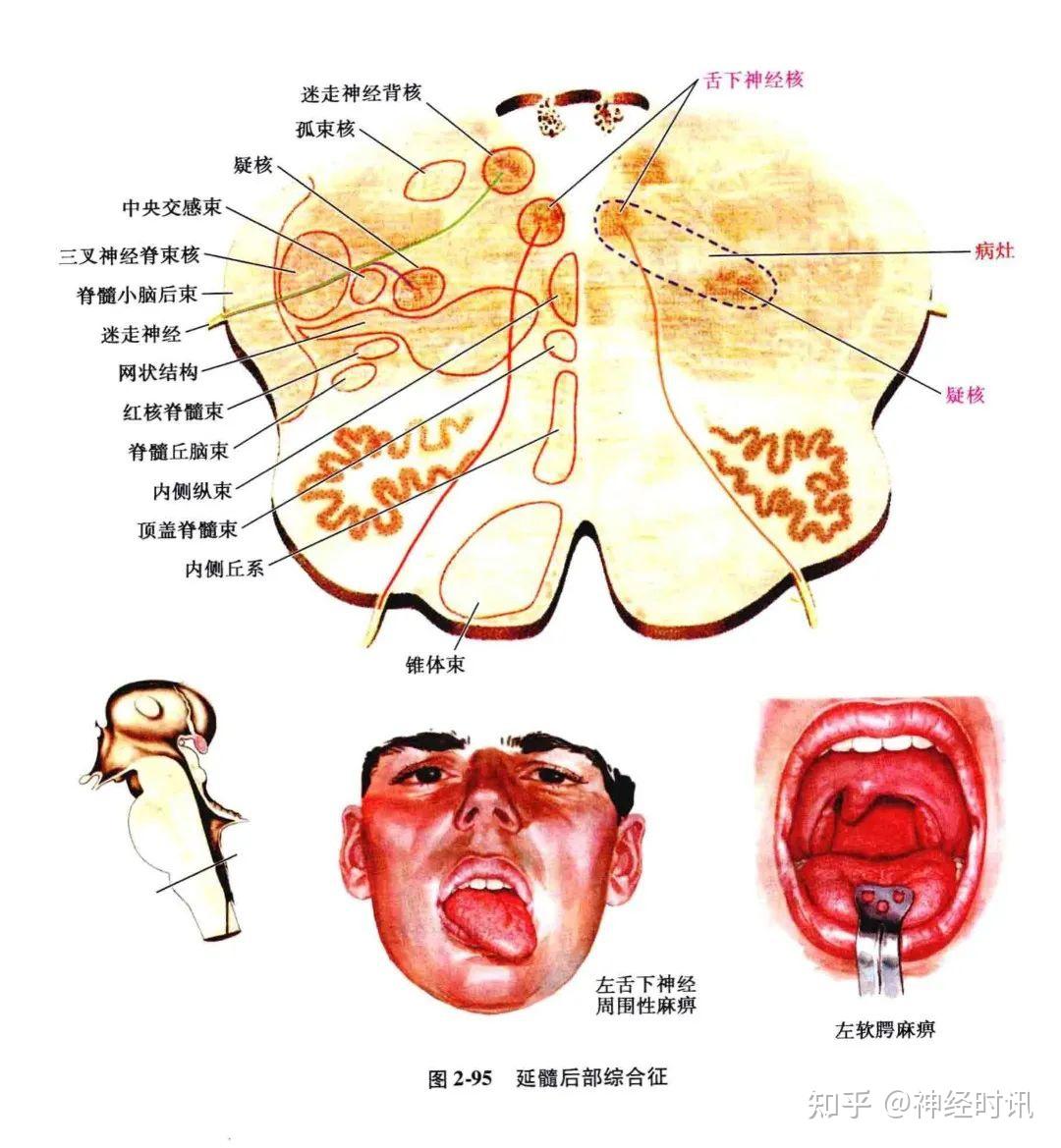 溫覺缺失和觸覺遲鈍;又由於舌咽,迷走神經和副神經(延髓)