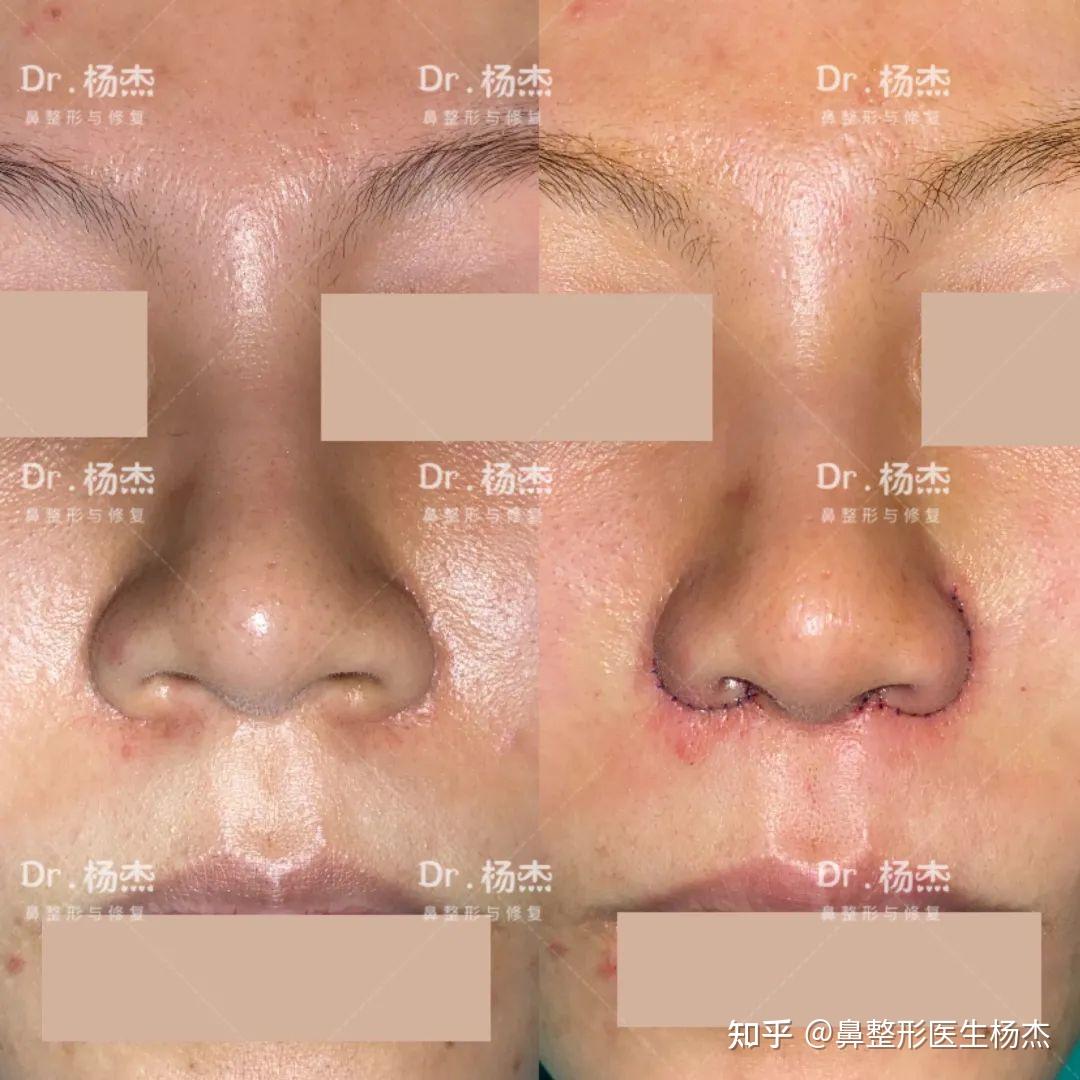 鼻槛整形之鼻槛过长