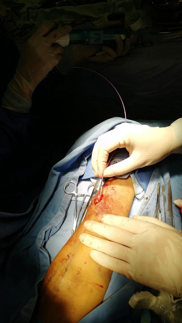 case左前臂动静脉内瘘切开取栓pta重建