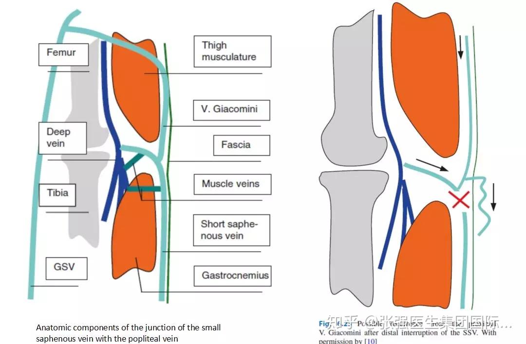 图片引用自:saphenous vein-sparing strategies in chronic venous