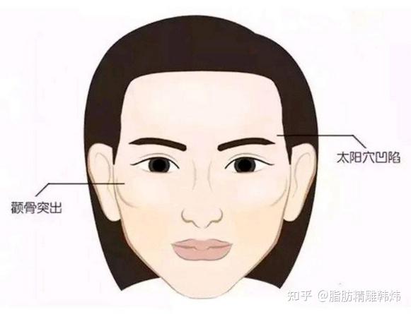 出现凹陷或本身就存在凹陷;另一种是颧骨外扩,就会反衬出颞骨处凹陷