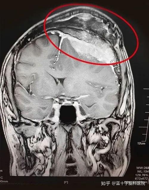 巨大脑膜瘤图例脑部肿瘤,尤其是原发性脑瘤和中枢神经系统恶性肿瘤
