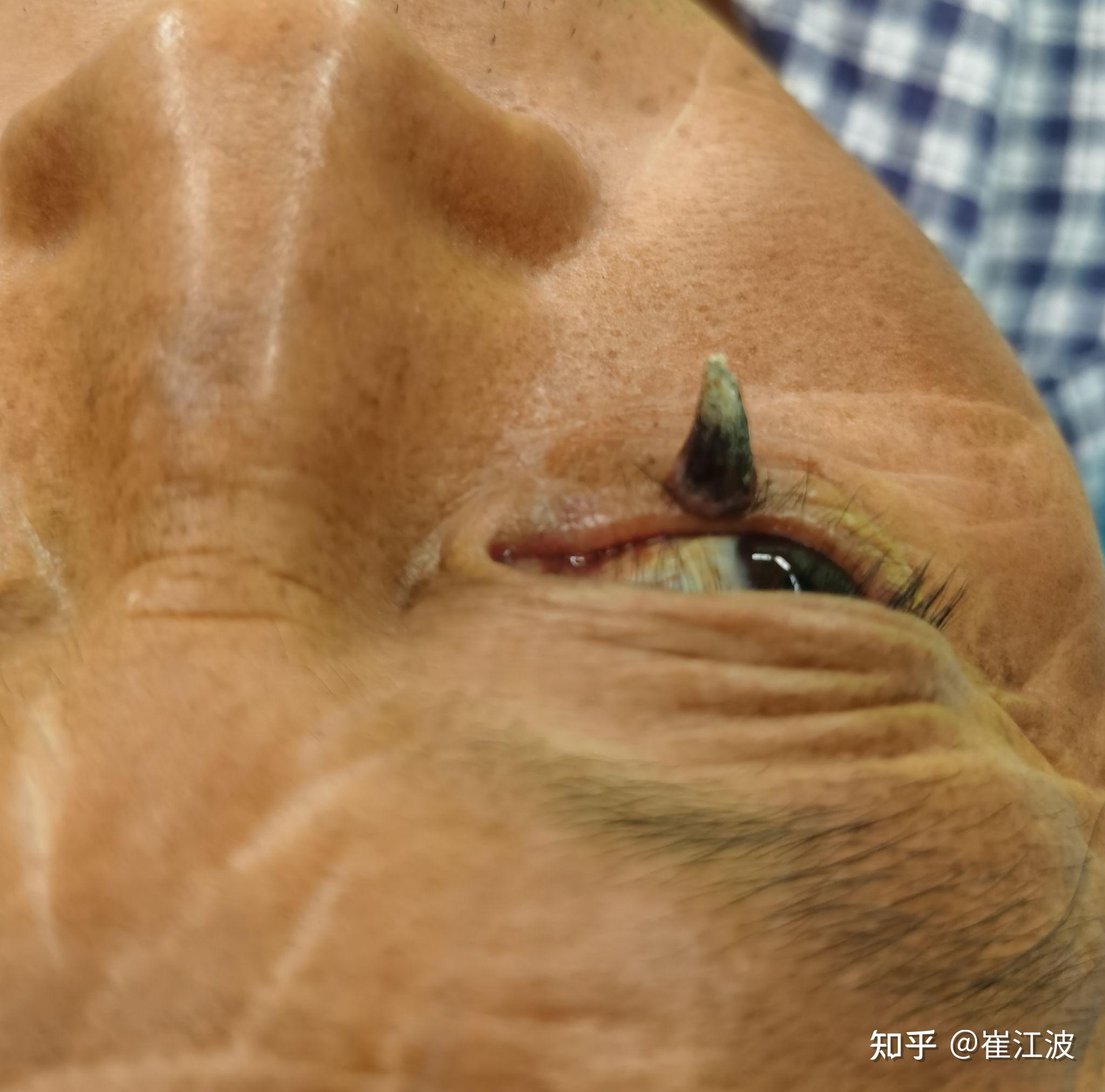 眼睑长犄角怎么办皮角的治疗