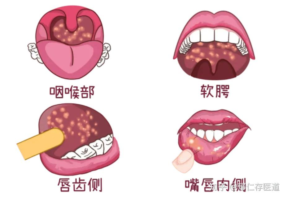 别把癌症当成了上火,出现7个症状,可能是口咽癌的预警 - 知乎