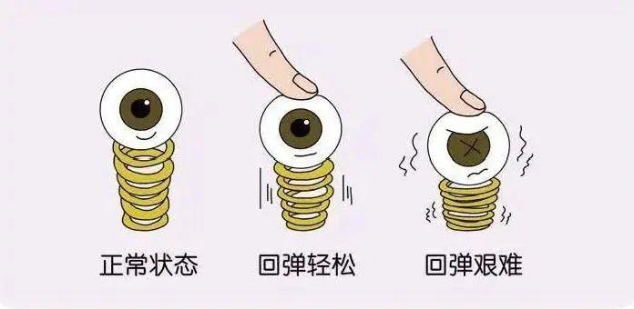 1,眼睛从正视发展为近视在近距离用眼时,眼睛为了看清近物,使睫状肌