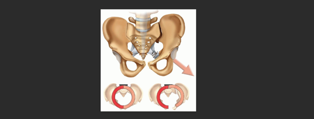 骨盆恥骨聯合周邊疼痛問題基礎解決思路