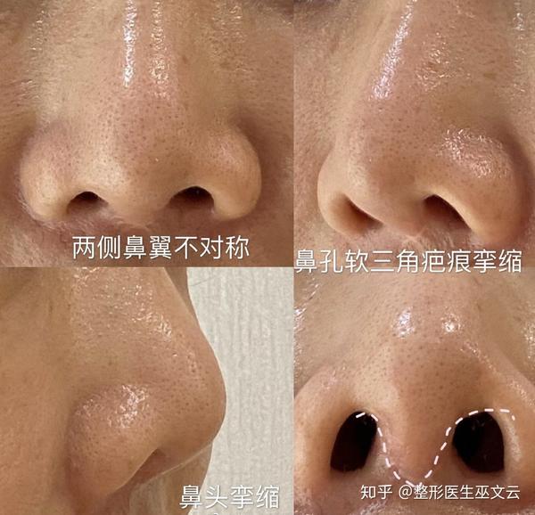 鼻整形 选内切口还是外切口 知乎