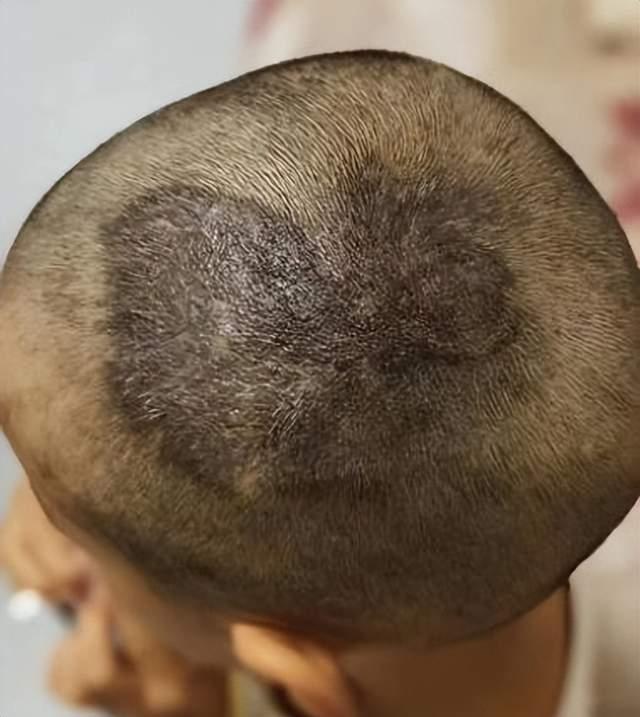 科发源疤痕植发(科发源植发多少钱一个单位)