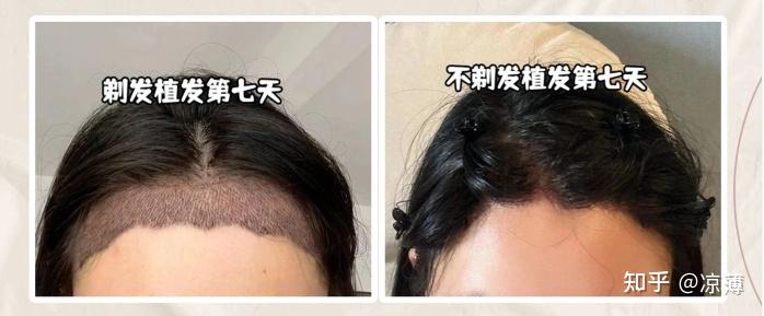 植发如何保证毛囊存活率合格的植发效果是什么样的这五点你们一定要看