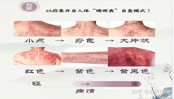 刮痧 - 知乎