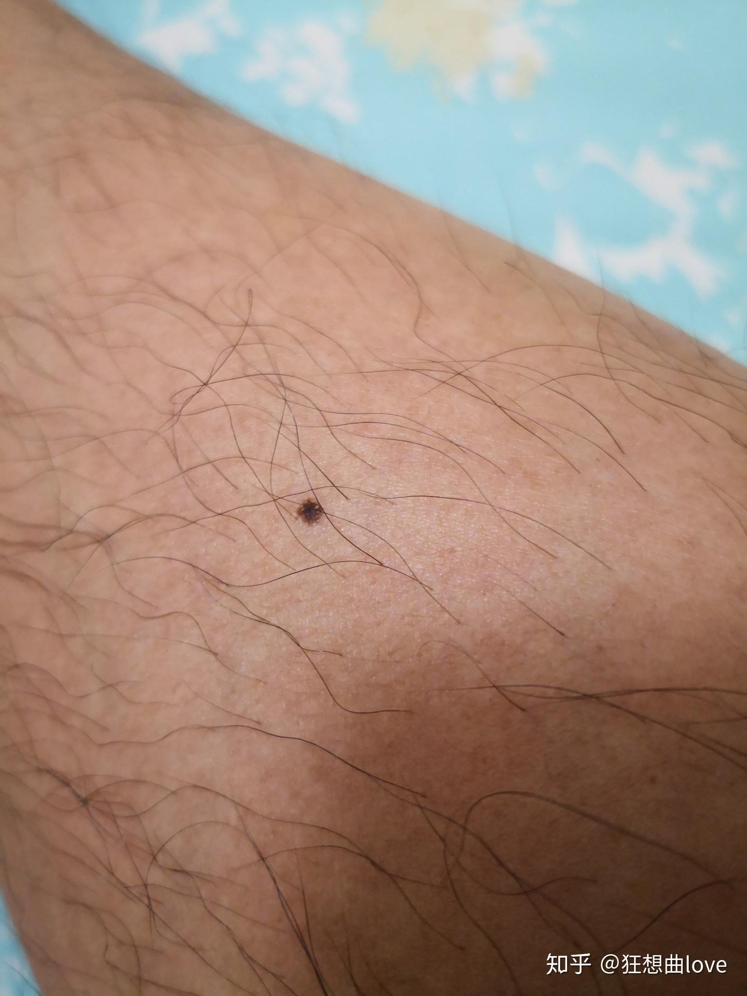 关注问题 67 写回答 登录/注册 皮肤科 身上忽然长出很多小黑点.