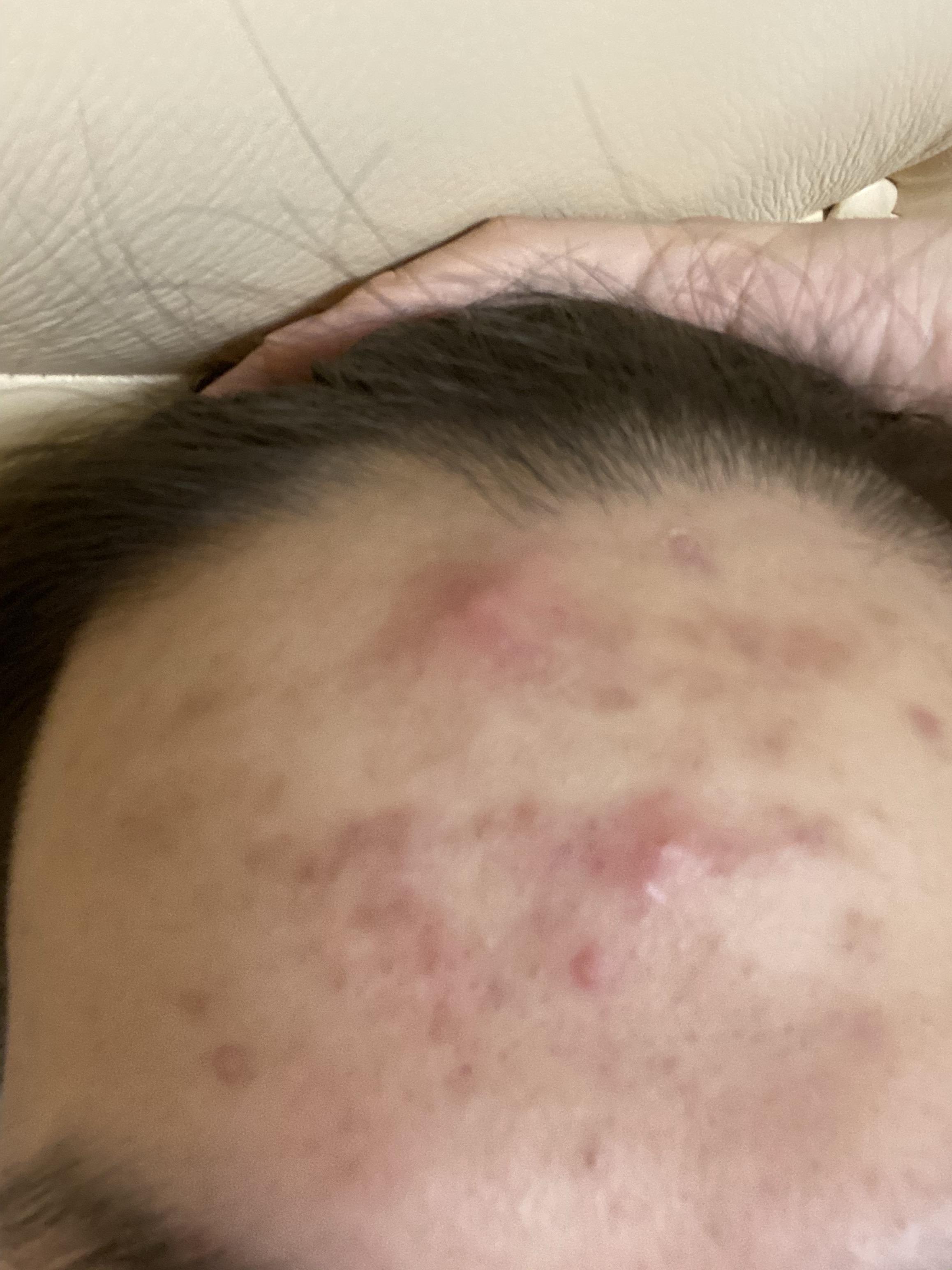 我额头长那种红肿硬的痘痘半个多月也没消也不冒白头我怎么才能让痘痘