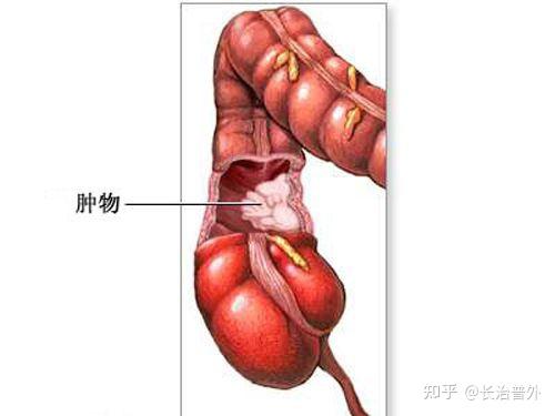 机械性肠梗阻图片图片