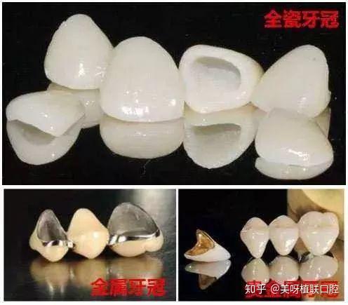 牙冠到底该怎么选什么牙冠最好