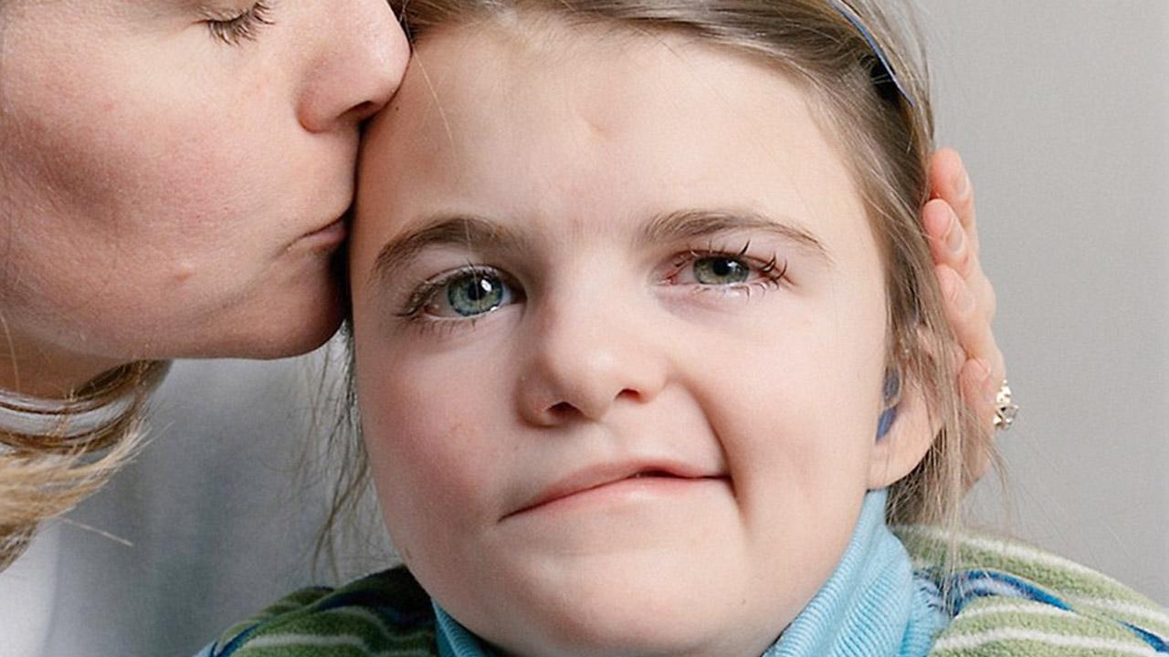 得了面瘫脸部活动受阻怎么办? 健康哥教你通过