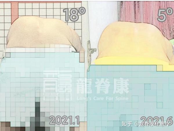 治疗仅仅半年,15岁男孩脊柱侧弯减少22°,剃刀背减少13° - 知乎