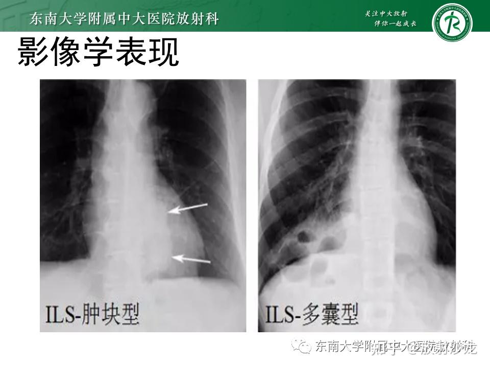 肺隔离症x线图片图片