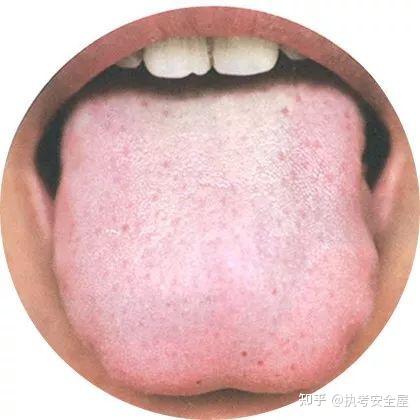【舌诊大全】120种常见的舌苔超清彩色图谱,建议收藏! - 知乎