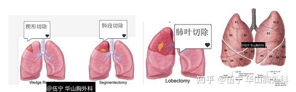 肺结节行肺叶肺段和楔形切除损伤多少肺组织和肺功能， 术后能恢复多少