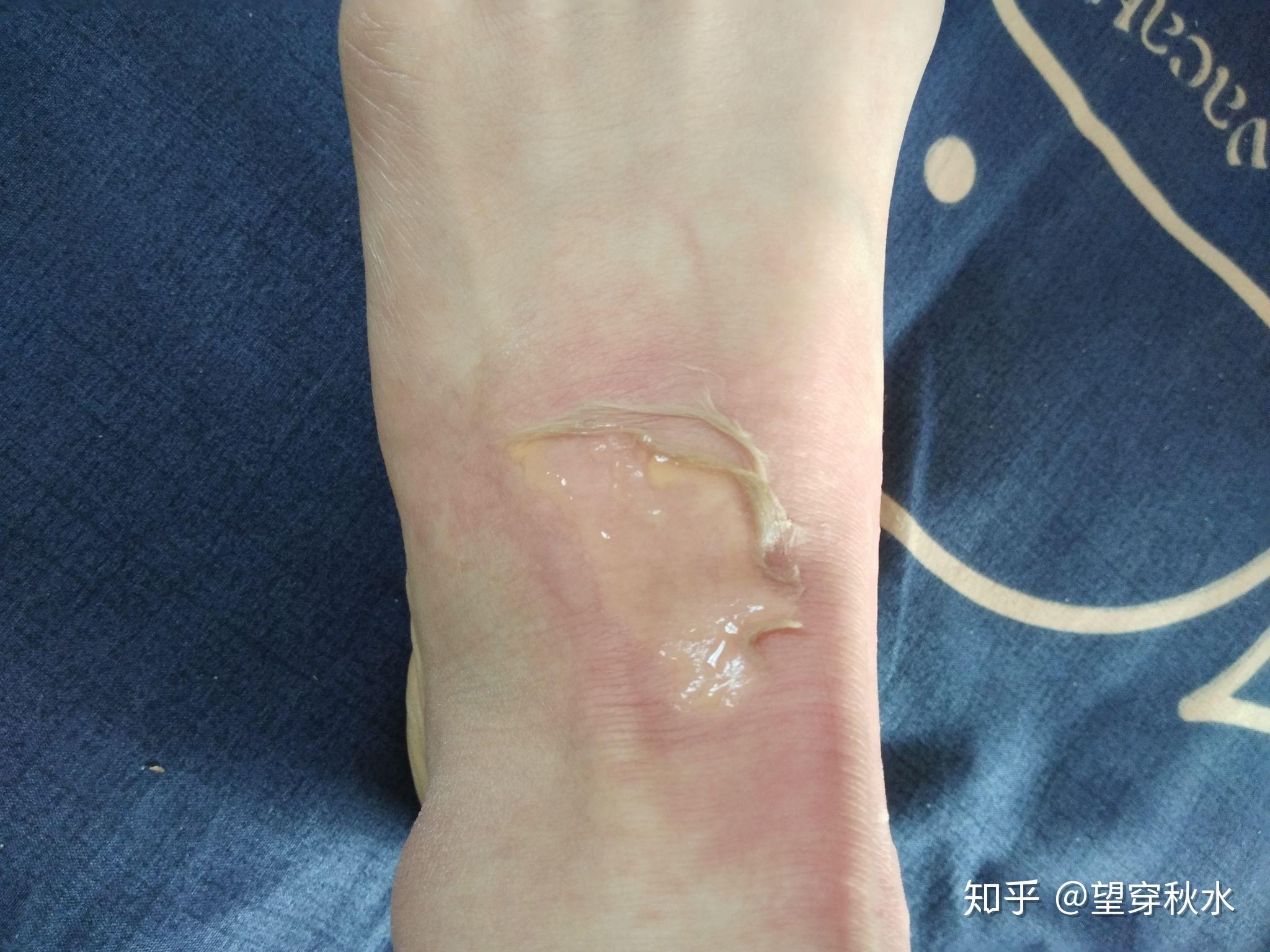 脚被开水烫了怎么办