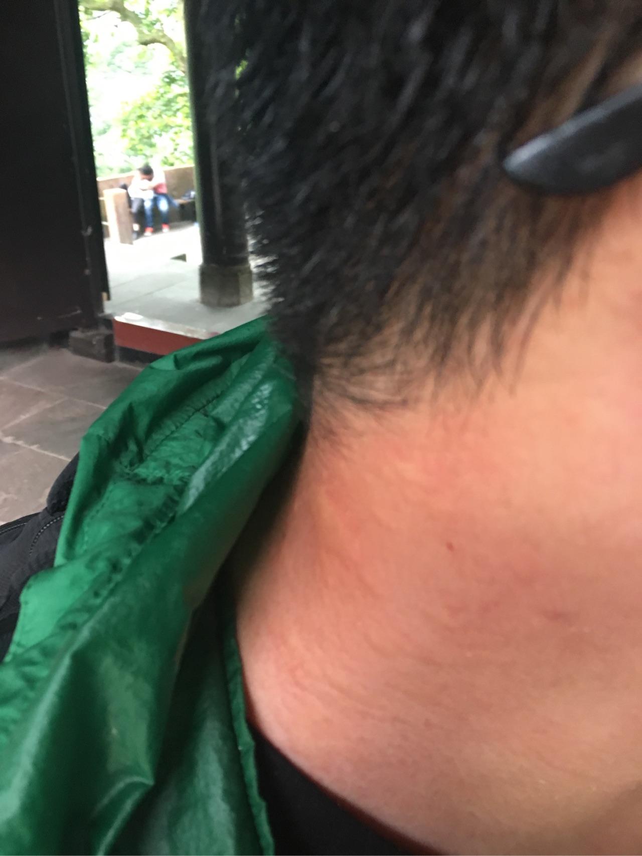 被毛毛虫刺到是一种怎样的体验