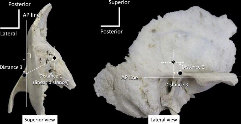 弓状隆起与颧弓根的定量解剖研究