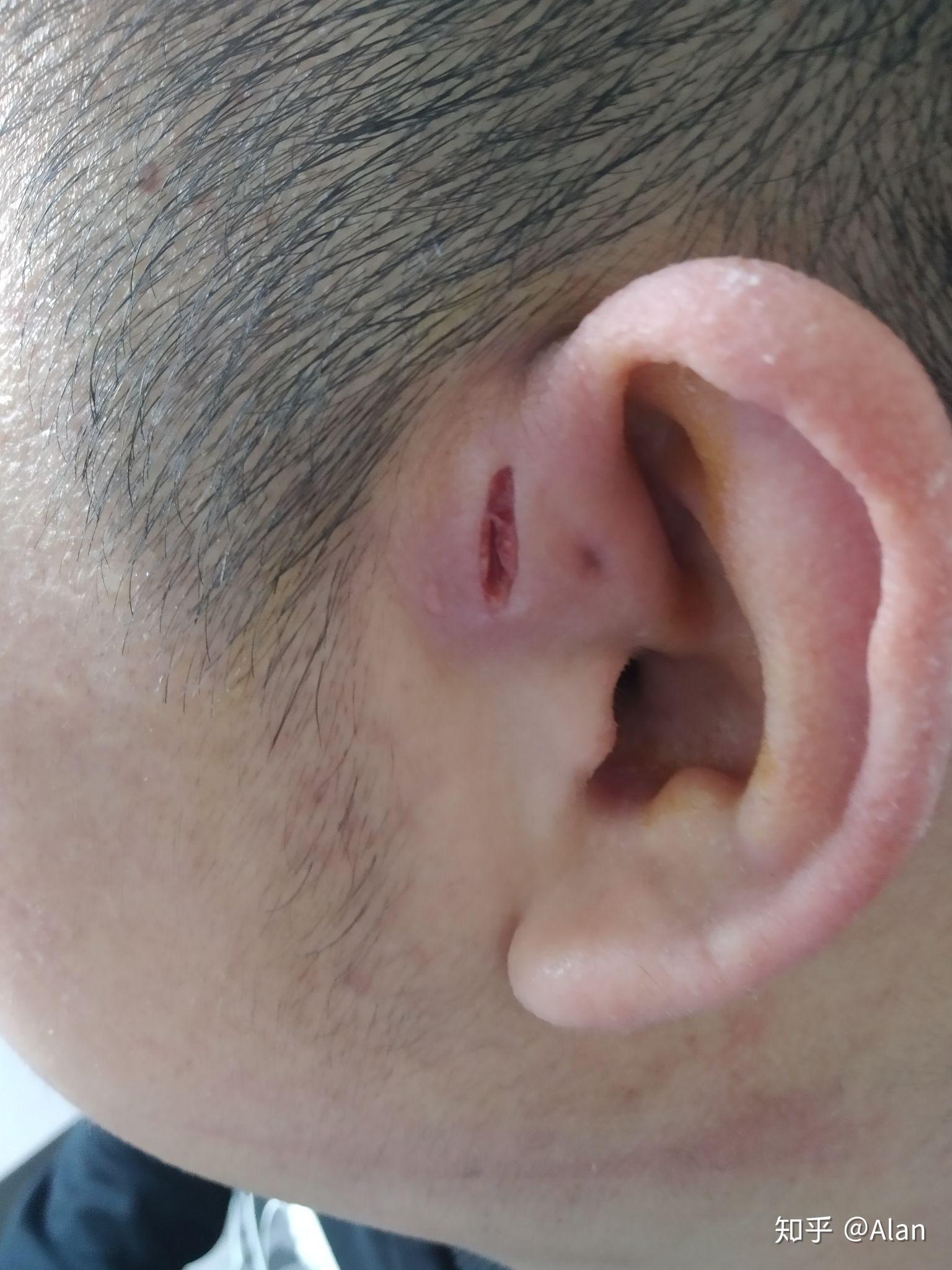 耳前瘘管手术留疤图片图片