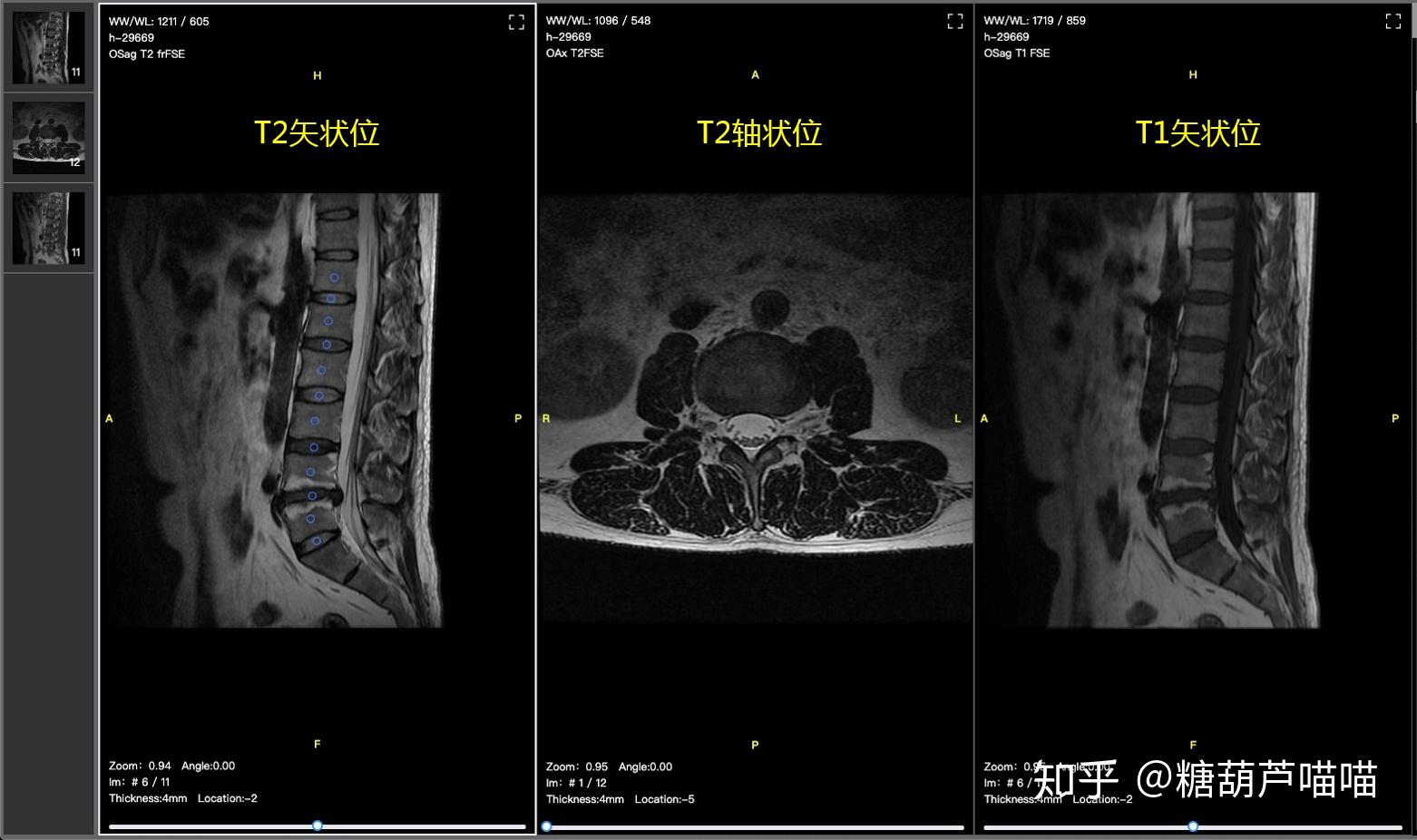 dicom影像包含t1和t2 矢状面影像,以及t2 轴状位影像(fse/tse):已标注