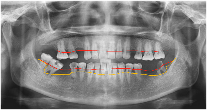 (牙周炎,牙槽骨广泛性吸收,红线为正常牙槽骨高度,黄线为现在牙槽骨