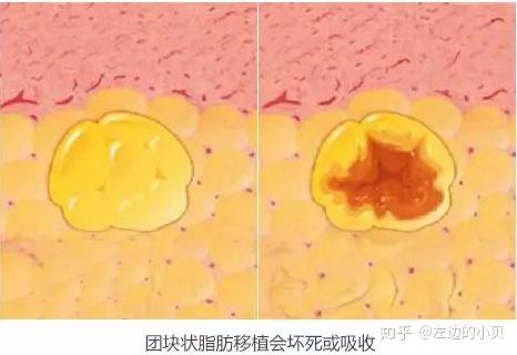 并且比较密集的情况下导致脂肪移植失败,大量的团化脂肪细胞在皮下