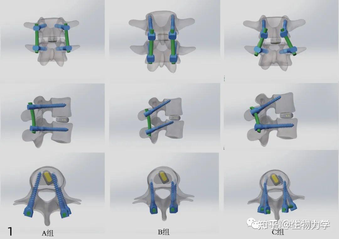 腰椎皮质骨螺钉联合椎弓根螺钉固定对融合节段应力影响的有限元分析