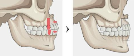 與牙性前突相比,骨性前突是由遺傳帶來的,因此後期在換牙期不管如何