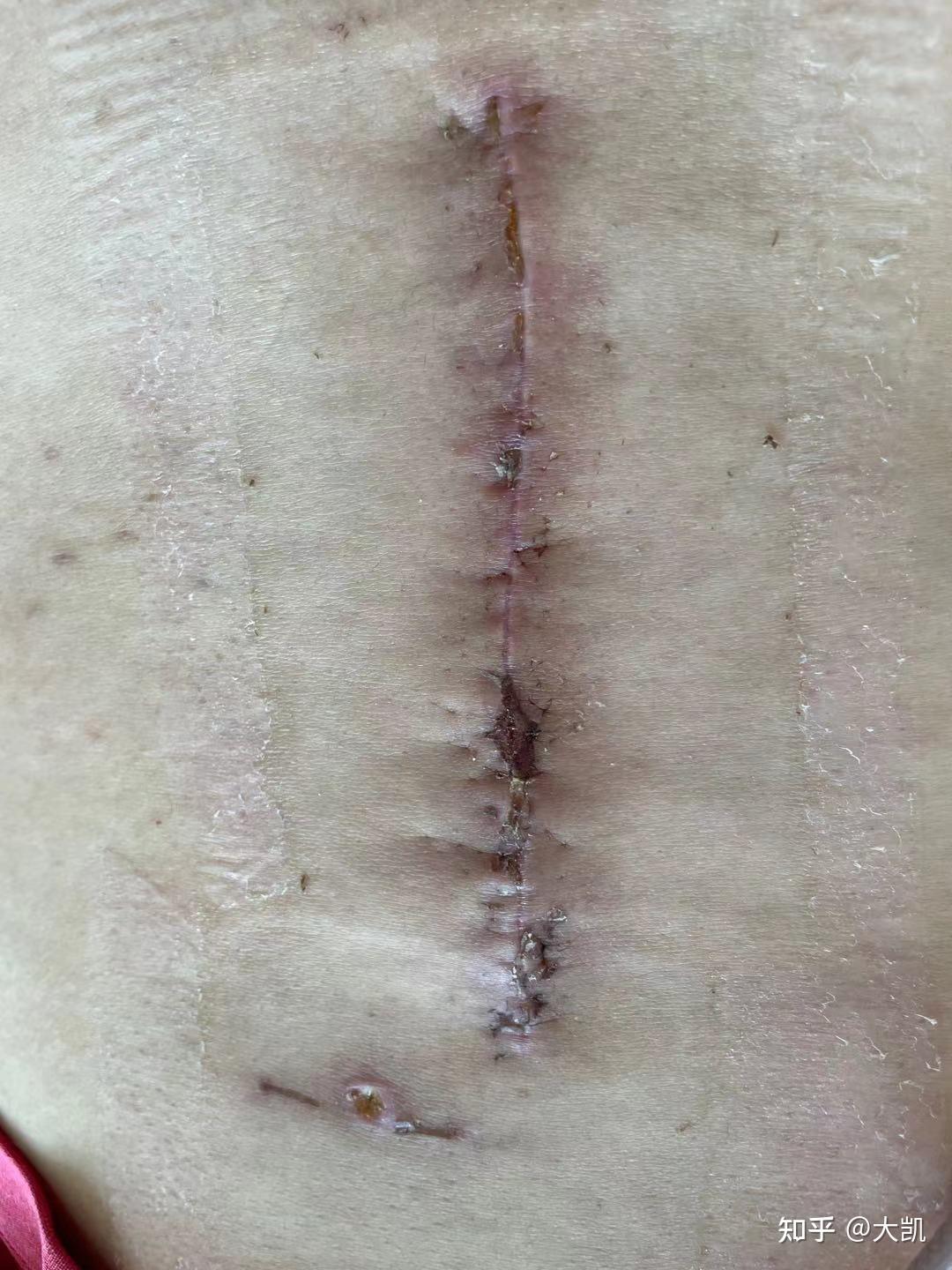 手术后伤口换药记录